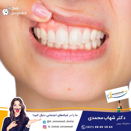 چه کسانی لیفت لثه انجام داده اند؟ - کلینیک دندانپزشکی دکتر شهاب محمدی